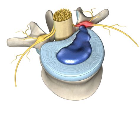 annular ligament tear test|annular ligament injury symptoms.